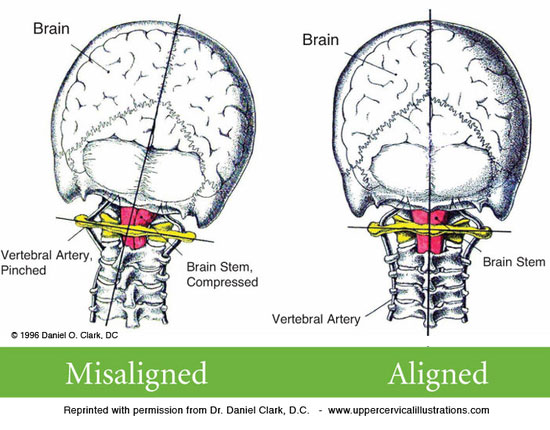 Misalignment